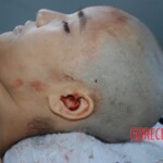 Autopsy of Chinese female