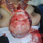 Autopsy of Chinese female