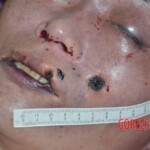 Strangled raped woman with cut nipple