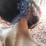 Hanged teenager with tumor