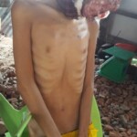 Hanged teenager with tumor