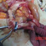 Stabbed and slashed girl