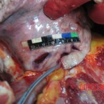 Stabbed and slashed girl