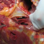 Stabbed and slashed girl