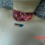 Stabbed and slashed girl
