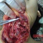 Stabbed and slashed girl