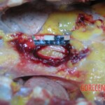 Stabbed and slashed girl