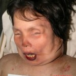 Dead woman in morgue