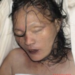 Dead woman in morgue