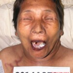 Dead woman in morgue