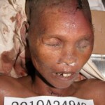 Dead woman in morgue