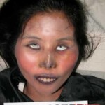 Dead woman in morgue