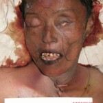 Dead female in morgue