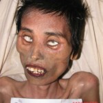 Dead female in morgue