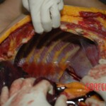 Chinese woman autopsy