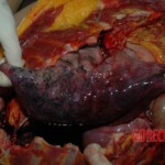 Chinese woman autopsy