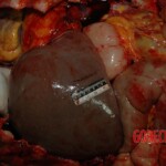 Chinese woman autopsy