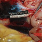 Chinese woman autopsy