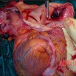 Aortic dissection