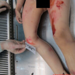 Examination of body of little Chinese girl