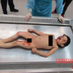 Examination of body of little Chinese girl