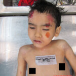 Examination of body of little Chinese girl