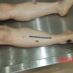 Naked woman in morgue