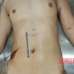 Naked woman in morgue