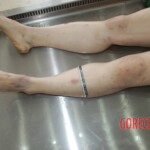 Naked woman in morgue