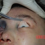 Naked woman in morgue