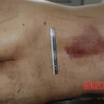 Naked woman in morgue