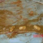 Autopsy of a drug mule