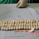 Autopsy of a drug mule