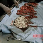 Autopsy of a drug mule
