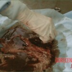 Autopsy of a drug mule