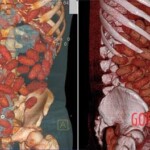 Autopsy of a drug mule