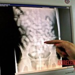 Autopsy of a drug mule