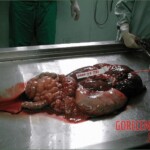 Autopsy of a drug mule