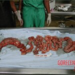 Autopsy of a drug mule