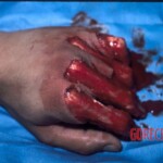 Degloving injury of fingers
