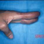Degloving injury of fingers