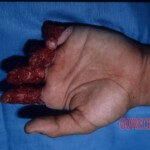 Degloving injury of fingers