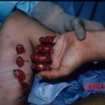Degloving injury of fingers