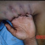 Degloving injury of fingers