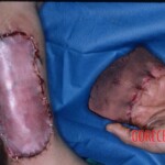 Degloving injury of fingers