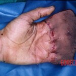 Degloving injury of fingers