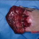 Degloving injury of fingers