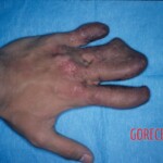 Degloving injury of fingers