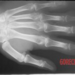 Degloving injury of fingers