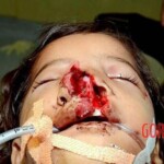 Surgery of little boy